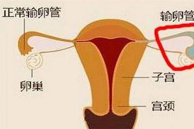 做试管发现输卵管积水该怎么办