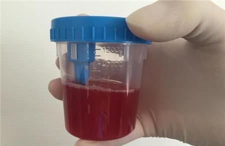 胆结石会出现尿潜血吗 尿血是胆结石引起的吗？
