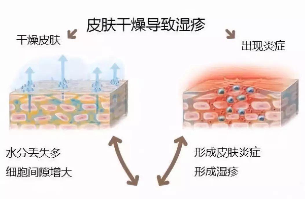 宝宝远离湿疹怎么护理