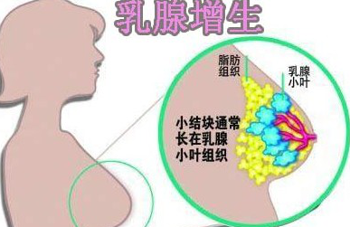 乳腺增生能除根吗 如何治疗乳腺增生好
