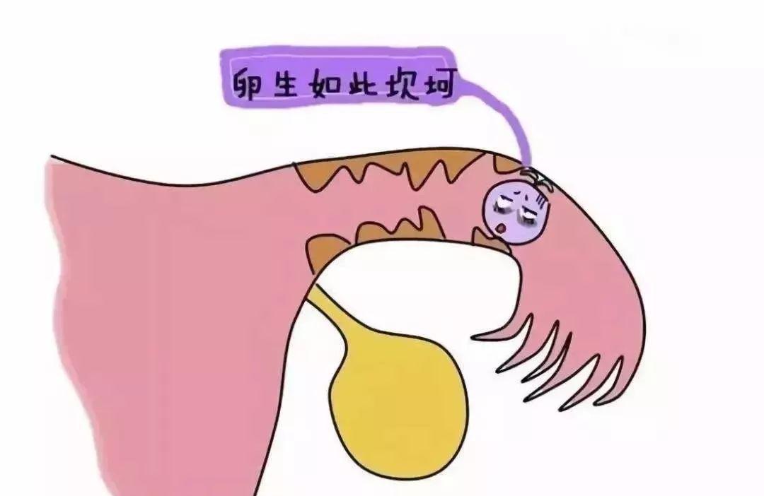 为什么宫外孕那么常见 切了输卵管怎么办