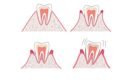 牙周炎对怀孕有影响吗 牙周炎严重吗？