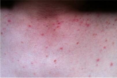 胸口长红疙瘩是艾滋病吗
