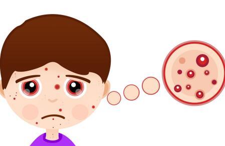 哺乳期额头长痘什么原因引起 多是这三方面原因造成