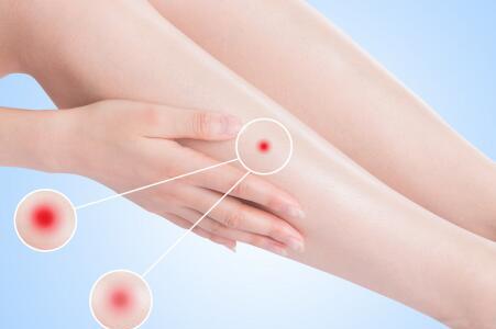 蜱虫叮咬后伤口图片 这种情况不要忽视