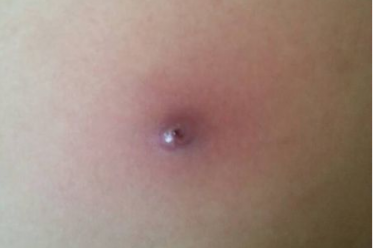 火疖子的快速治疗方