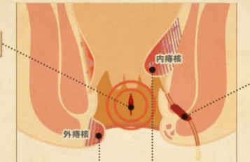 效果最好的痔疮药，网友分享痔疮的最佳治疗药物