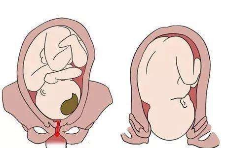 生完孩子阴道松弛怎么办？有效的解决办法在这！