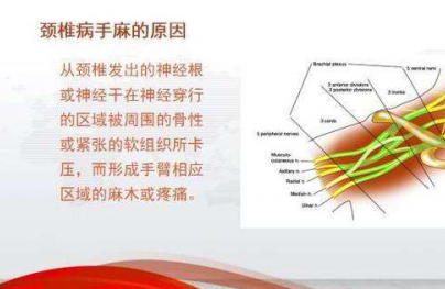 手麻怎么治疗？睡觉手麻是什么原因引起的？可能是它