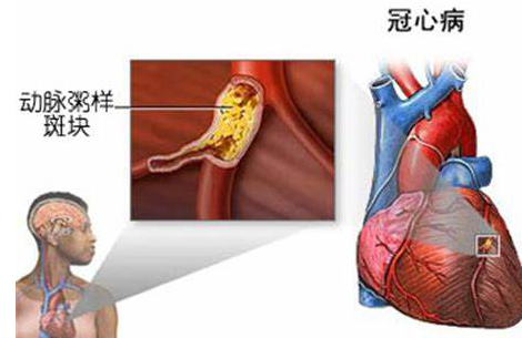 心绞痛怎样治疗？心绞痛是什么原因引起的让你秒懂