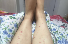 成都银康紫癜医院好不好：常被患者用来治疗过敏性紫癜的方法 !