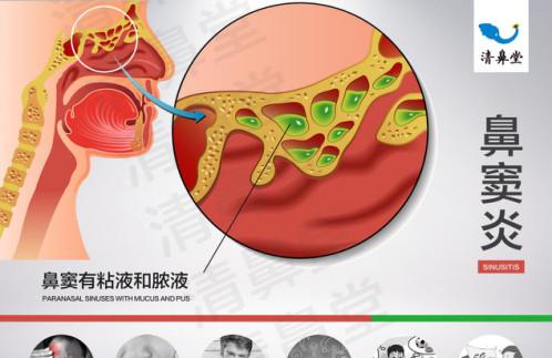 王大爷感冒总不好?时隔半年才发现原来是这个原因……