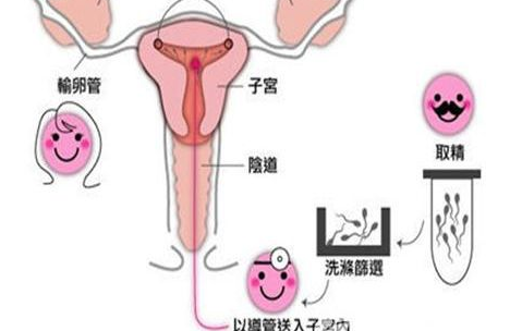 宫寒不孕可以人工受精吗
