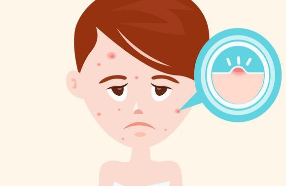 宫寒额头长痘痘吗