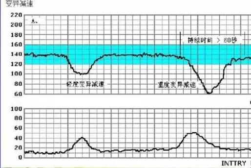 胎心监护胎心减速的三种曲线 胎心减速分为哪三种