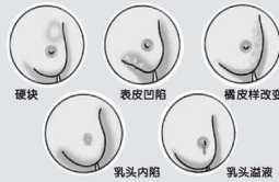 乳腺纤维瘤多大比较严重 女性乳房纤维瘤严重吗