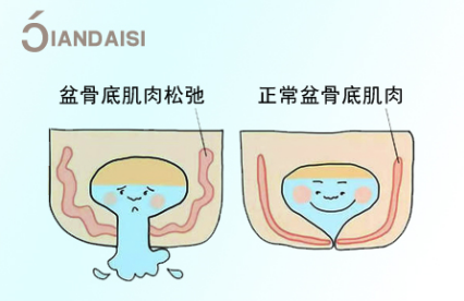【真实作用】缩阴产品可以改善漏尿吗？