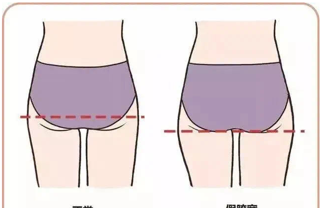 产后妈咪大腿粗，臀部大，可能是假胯宽！
