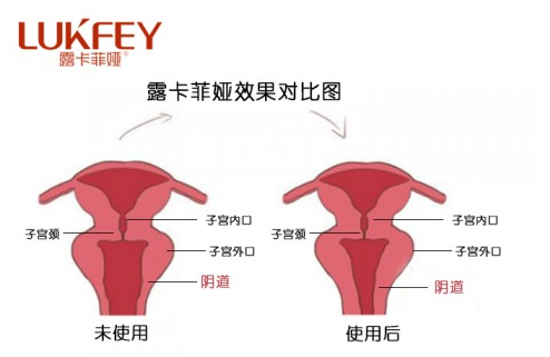 露卡菲娅销售数十年，斩获女性缩阴领导品牌！