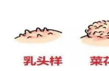 尖锐湿疣的早期症状咋识别？降低尖锐湿疣治疗费用有捷径