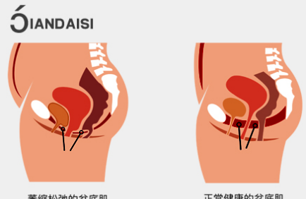 提肛运动真的能缩阴吗？提肛运动害了多少人