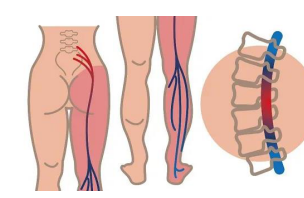 坐骨神经痛的锻炼方法试试这5种，坐骨神经痛的治疗方法少不了它！