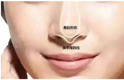 宁波薇琳是正规医院吗：隆鼻安全吗？看了这些你就知道了！
