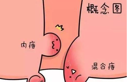 内痔疮用什么药效果好?内痔疮的最佳治疗方法