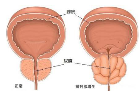 前列腺增生吃什么药好，前列腺增生的治疗方法“绿色疗法”