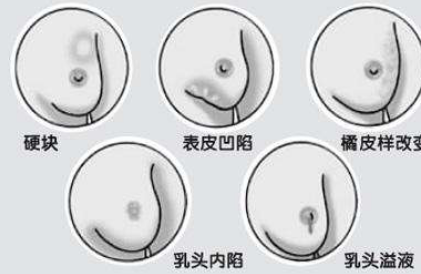 怎样缓解乳腺增生疼 乳腺增生刺痛要紧吗