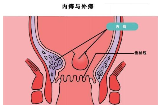 治疗痔疮的药？痔疮膏哪种好？