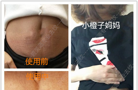 碧芙源可以去妊娠纹不 碧芙源真实去纹效果反馈