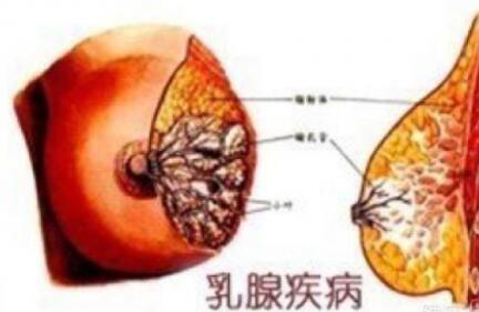 乳腺增生吃药能治好吗 乳腺增生怎样才能根治