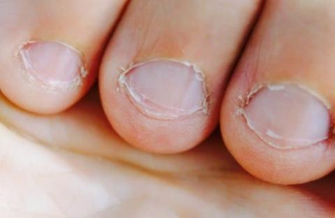 孩子老是咬指甲是什么原因导致的？