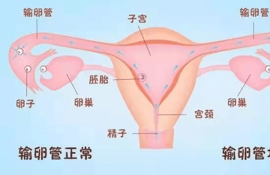 输卵管造影全程步骤
