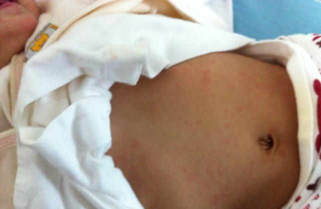 宝宝6个月后“第一次发烧”，大多是幼儿急疹，6-12个月娃要注意