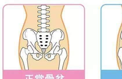 生娃后骨盆变大致腰疼，别忽视修复问题，赵丽颖都没逃开