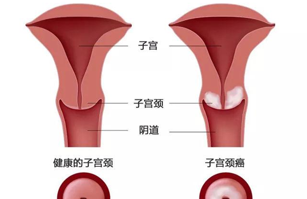 什么是宫颈炎?宫颈炎会影响怀孕吗