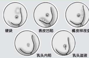 乳腺结节科研新疗法引热议 专家：归功乳蓓康