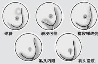 乳腺增生不治会怎样 有乳腺增生不可小觑