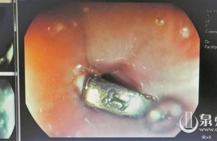 一枚硬币 在孩子食道卡了一星期