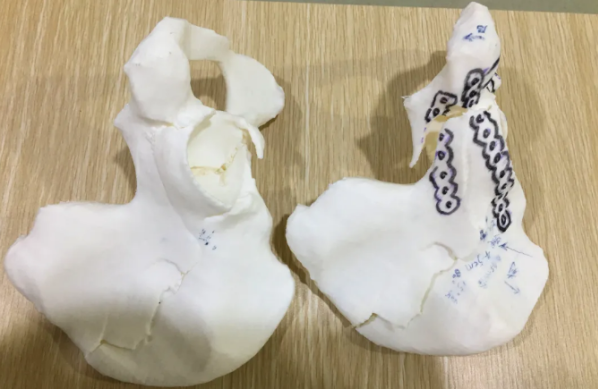 南京邦德骨科医院将3D打印技术 成功应用于复杂性骨盆骨折