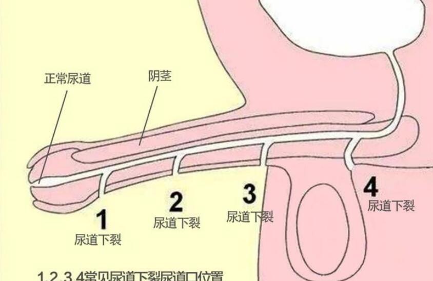 成都博大泌尿外科医院“尿道成型术”解除患者尿道下裂困扰！