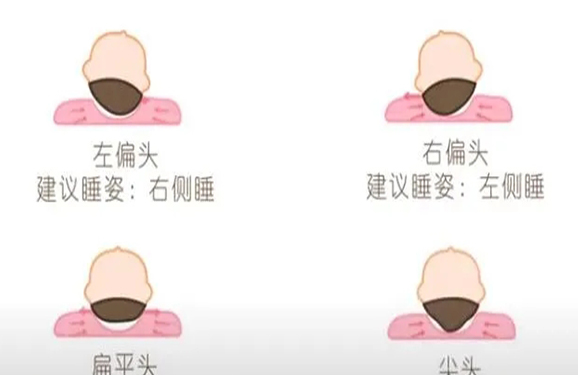 新生儿怎样才能把头睡成圆的 左右睡可轻松拥有漂亮头型