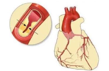冠心病心肌缺血有什么症状和表现？心肌缺血吃什么药？