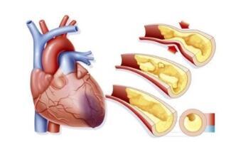心肌缺血有什么症状和表现？冠心病熬夜有猝死的风险吗？熬夜到什么程度会猝死？